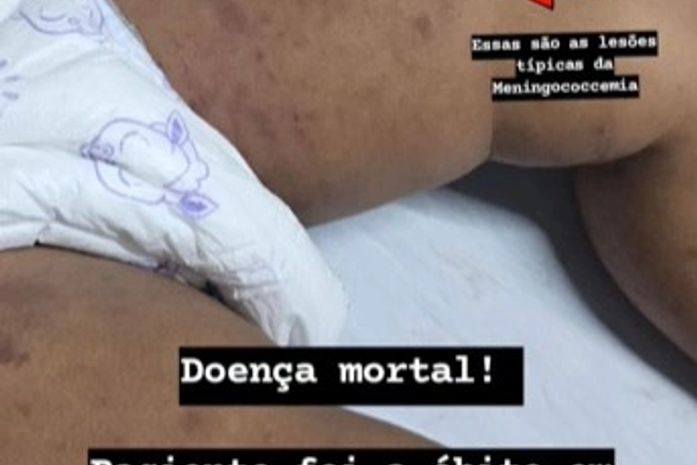 HGE confirma óbito de bebê por meningite; técnicos da Sesau acompanham o caso