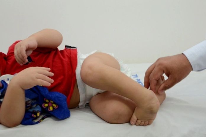 Sesau promove mutirão de triagem para tratamento de pé torto