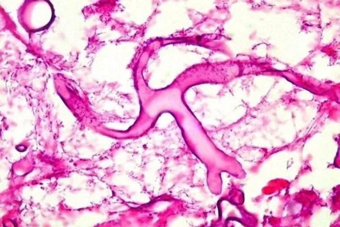 Mucormicose