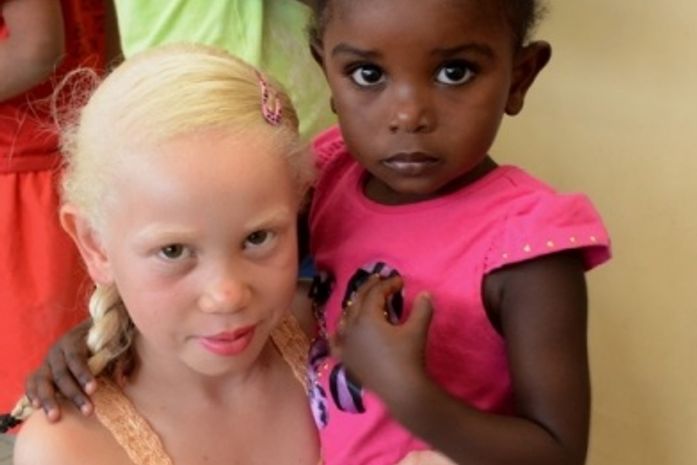 AL celebra Dia Mundial de Conscientização do Albinismo com a efetivação da Linha de Cuidados no Âmbito do SUS