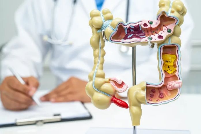 Alimento reduz em 20% o risco de câncer de intestino, revela novo estudo