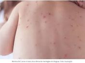 Meningite