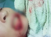 Polícia Civil investiga caso de mulher que teve os lábios arrancados em Viçosa