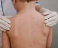 Sem vacina no SUS, sorotipo B predomina nos casos de meningite em Maceió, explica infectologista

