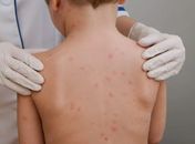 Sem vacina no SUS, sorotipo B predomina nos casos de meningite em Maceió, explica infectologista

