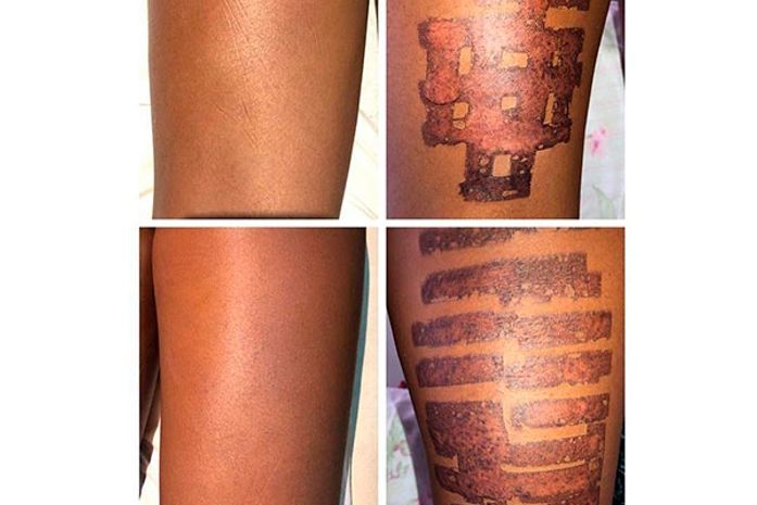 Modelo teve queimaduras do 2º grau