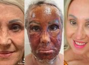 Mulher "troca de rosto" após realização de procedimento estético