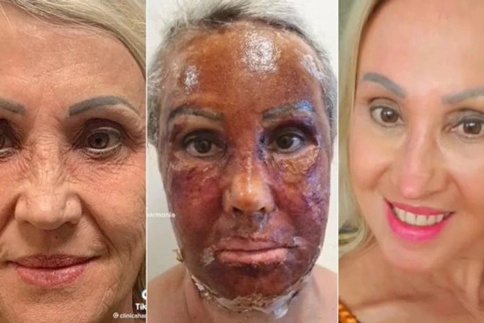 Mulher "troca de rosto" após realização de procedimento estético