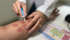 Manchas na pele e dormência podem indicar hanseníase; hospital orienta população em Maceió