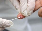 Casos de Aids caem 400% em Arapiraca