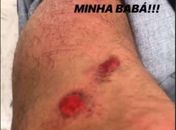 Apresentador da Globo sofre acidente de bicicleta e posta estrago na Internet