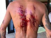 Imagem forte! Líder do ranking no surfe, Filipinho se machuca e exibe ferida gigante