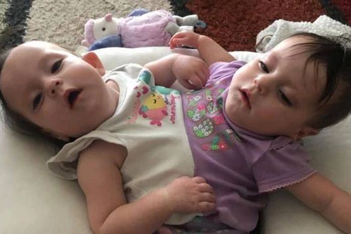 Gêmeas siamesas andam pela 1ª vez com ajuda de aparelho