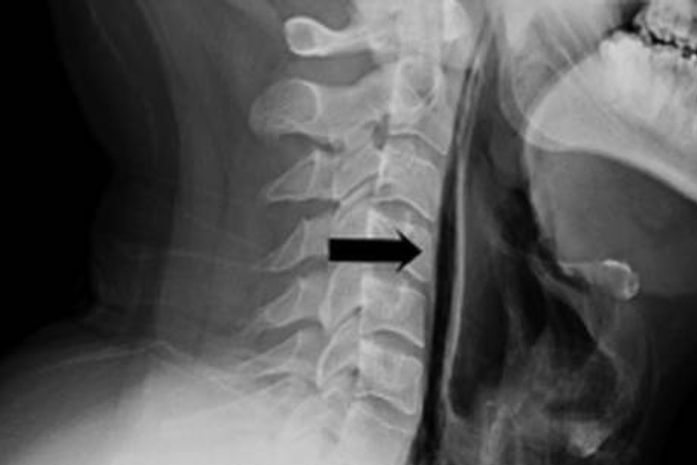 Homem rompe garganta ao segurar espirro e leva médicos a fazerem alerta