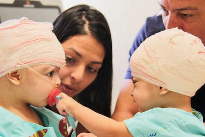 Gêmeas siamesas separadas no DF comemoram aniversário de 1 ano