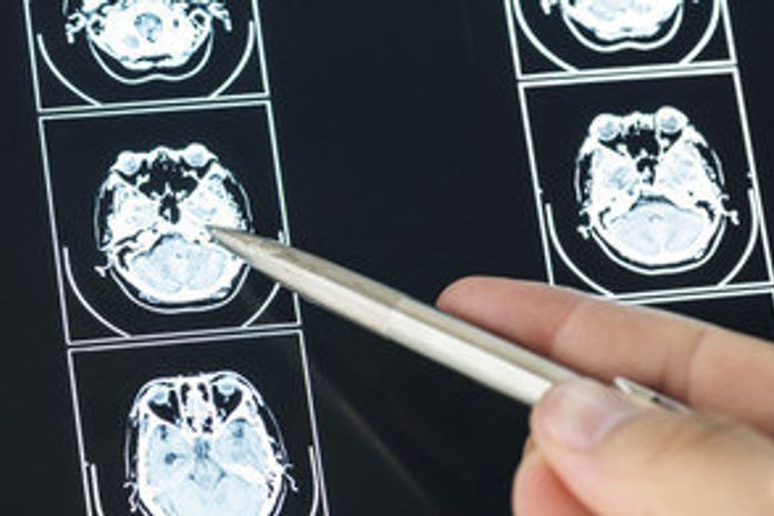 Mulher fica aliviada ao saber que suposto tumor cerebral era verme