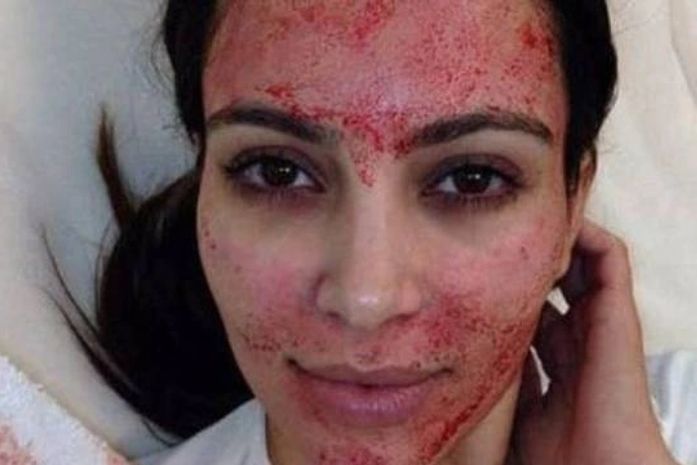 Duas pessoas podem ter contraído HIV após lifting de vampiro nos EUA