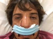Surfista brasileiro sofre grave acidente na onda e rasga o nariz
