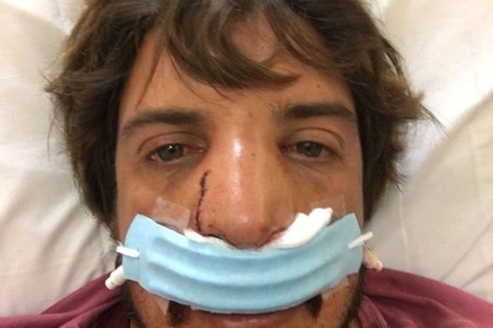 Surfista brasileiro sofre grave acidente na onda e rasga o nariz