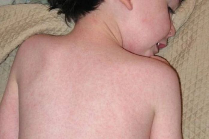 Número de casos de sarampo no Brasil é o maior em 20 anos