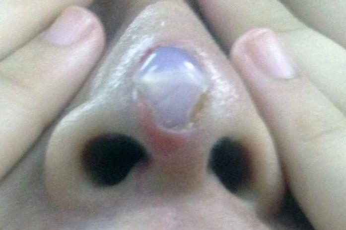 Rinoplastia dá errado e implante de silicone começa a sair de nariz da mulher