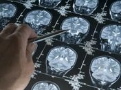 Teste genético é uma das estratégias de diagnóstico
