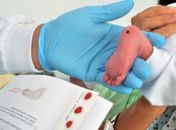 Dia do Teste do Pezinho: Pediatra da Sesau ressalta a importância do exame para diagnosticar doenças precocemente